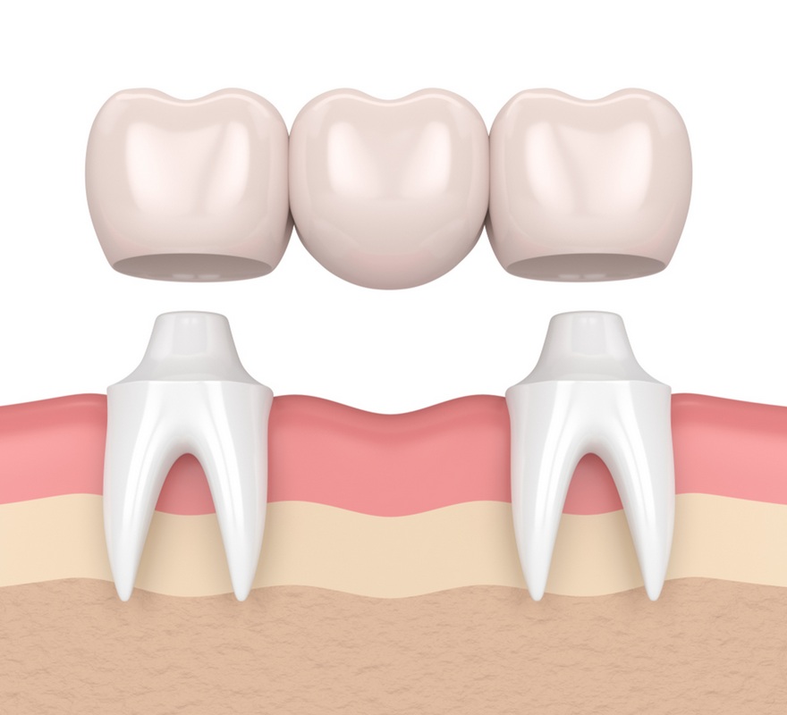 dental bridges in edmonton