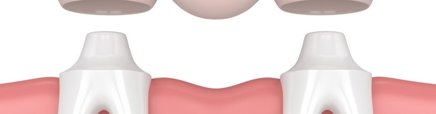 dental bridges in Edmonton