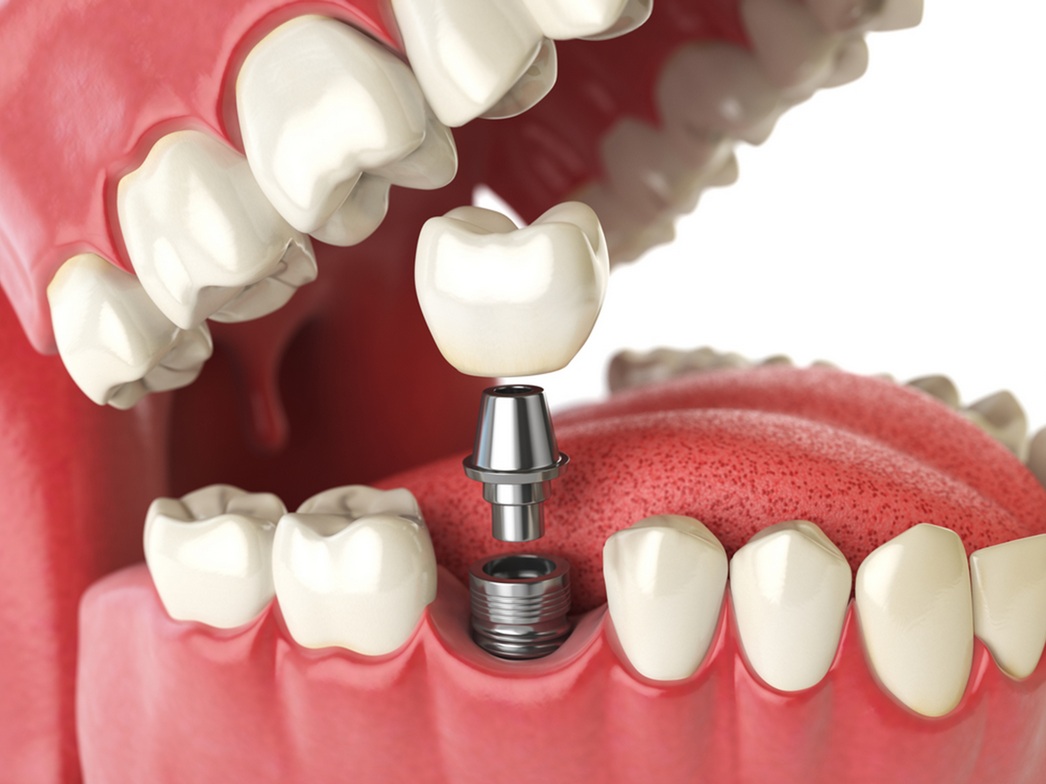 dental implants in edmonton