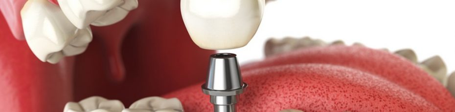 dental implants in Edmonton
