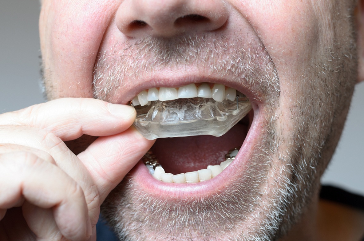 mouth guards in edmonton