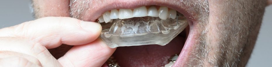 mouth guards in Edmonton