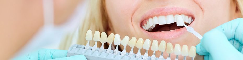 teeth whitening in Edmonton