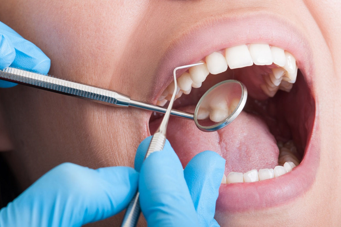 tooth extractions in edmonton