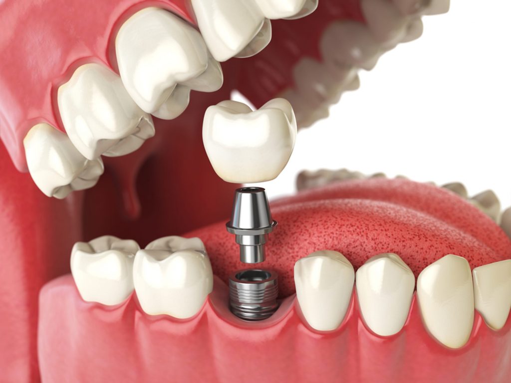 a more in depth look into dental implants