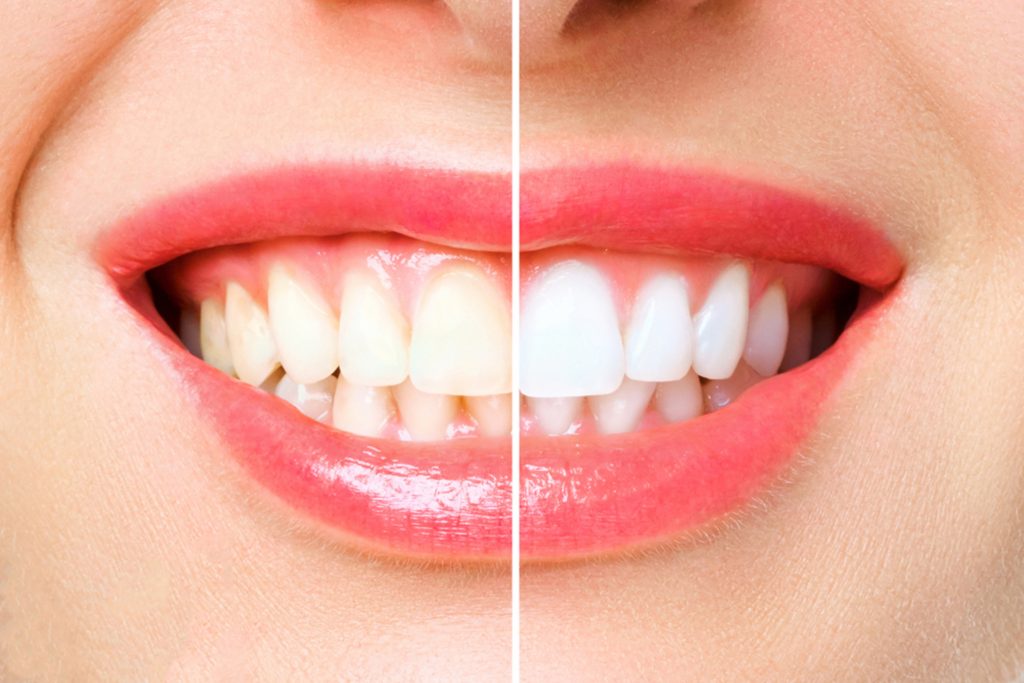 the complete guide to professional teeth whitening