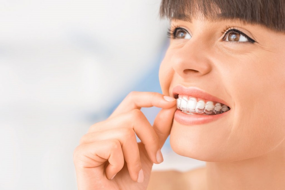 things to know before getting invisalign