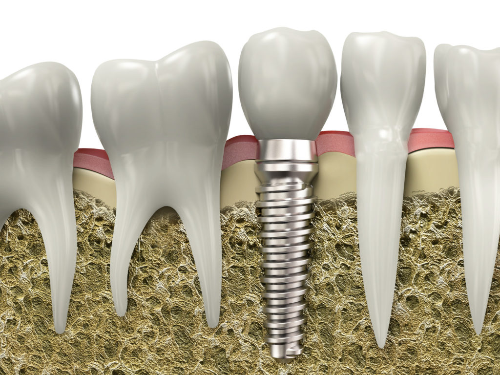 six easy ways to maintain your dental implants