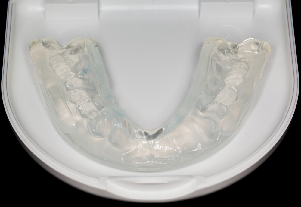 are invisalign braces good for overbite