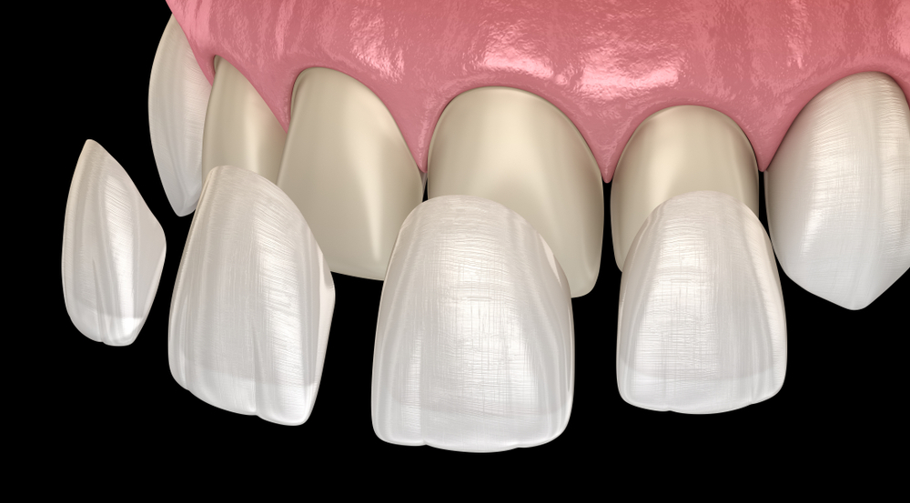 what is the lifespan of porcelain veneers