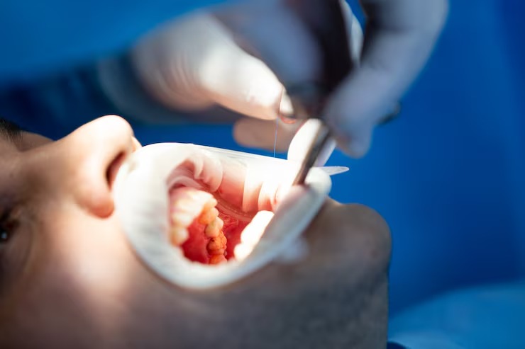 Small cavity why early dental fillings matter