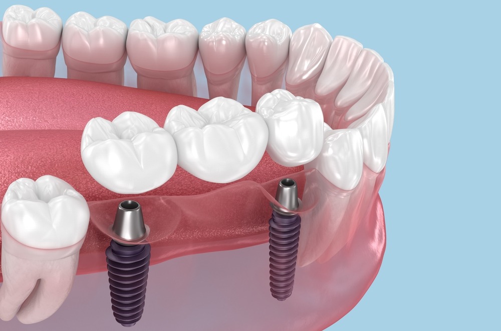 dental bridges explained is the procedure painful